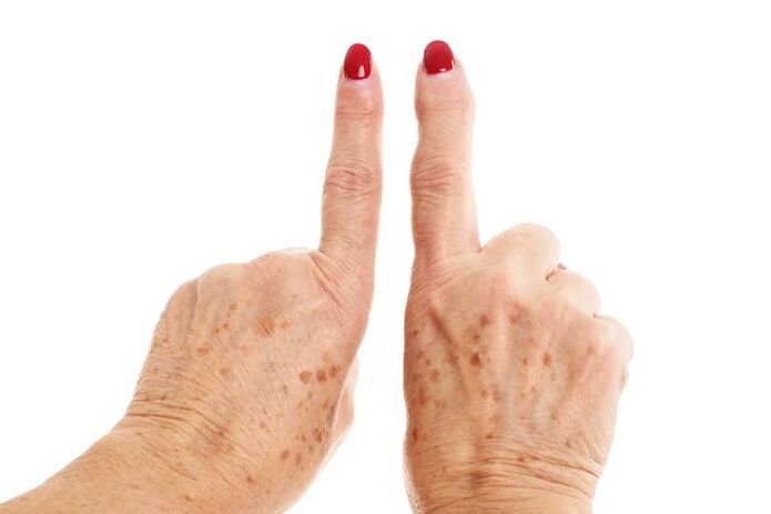 تغییر شکل آرتروز در انگشتان دست