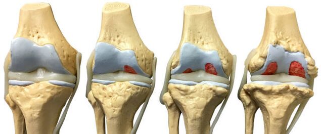 آسیب مفصلی در مراحل مختلف توسعه آرتروز مچ پا