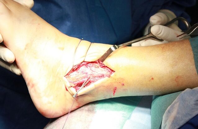 جراحی برای آرتروز مچ پا