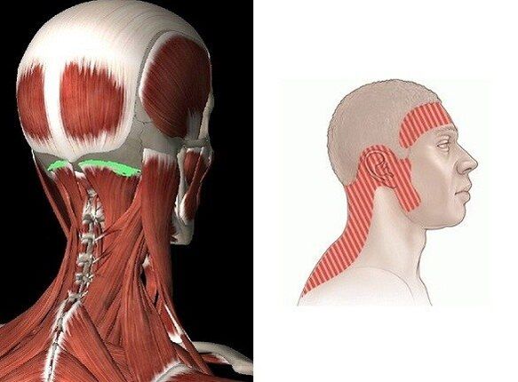 درد در ناحیه گردن