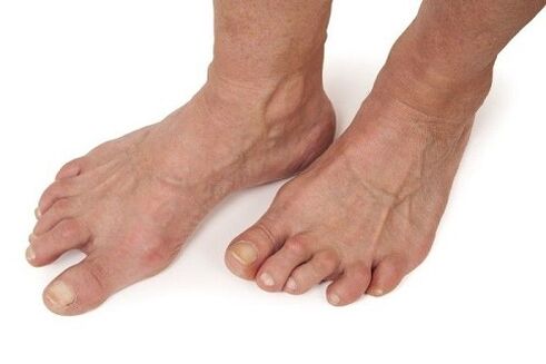 پاهای مبتلا به آرتروز