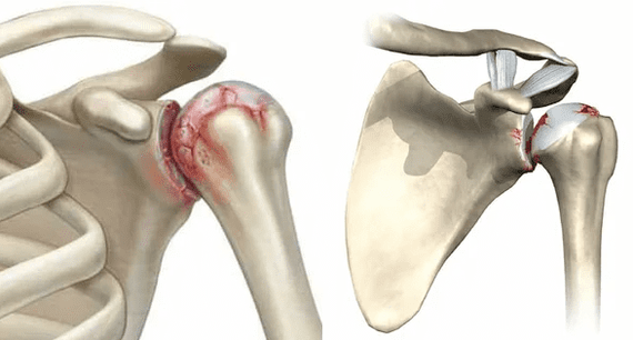 آرتروز مفصل شانه چگونه است