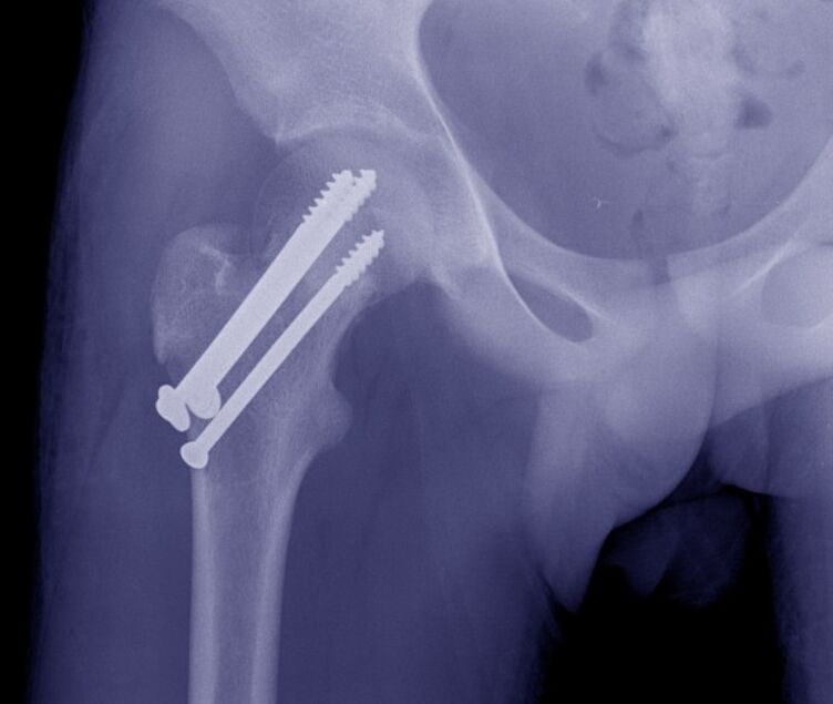 اشعه ایکس مفصل ران ، استئوسنتز شکستگی با دستگاه های ثابت کننده داخلی