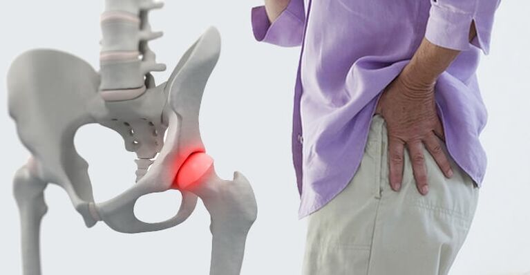 درد در ناحیه ران - علامت آرتروز مفصل ران است